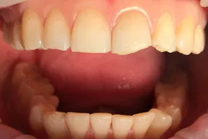 Художественная реставрация переднего зуба, фото до