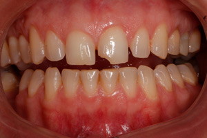 Художественная реставрация переднего зуба, фото до
