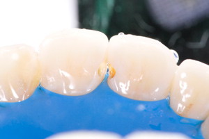 Лечение кариеса передних зубов, фото до