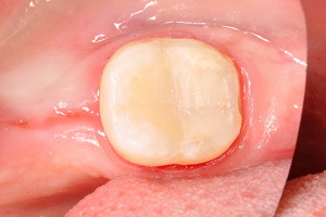 Реставрация жевательного зуба после лечения пульпита, фото после