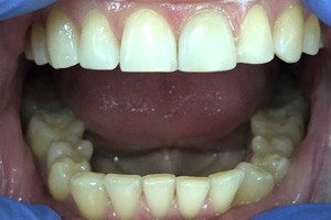 Художественная реставрация переднего зуба, фото после