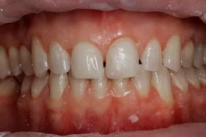 Художественная реставрация переднего зуба, фото после