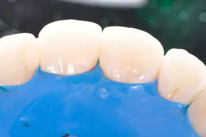 Лечение кариеса передних зубов, фото после