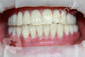 Имплантация при полной адентии зубов