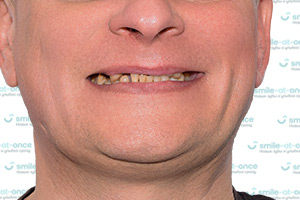 All-on-6 с 2 Zygoma и новые красивые зубы за 3 дня ДО