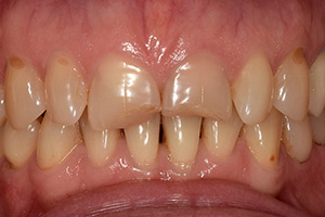 Виниры на зубы верхней челюсти