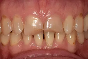 Виниры на зубы верхней челюсти ДО