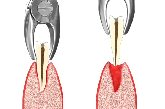 Удаление зубов различной сложности со скидкой