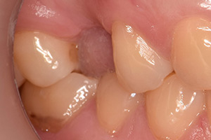 Одиночная имплантация зубов Straumann ДО