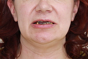 Имплантация после зубных протезов