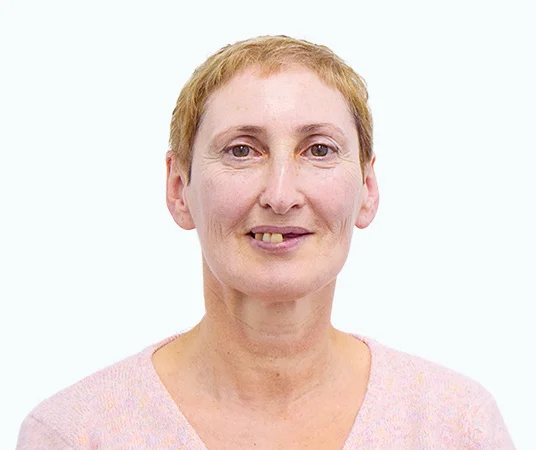 Фото: до комплексной имплантации