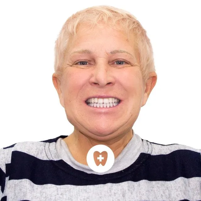 Фото после имплантации зубов