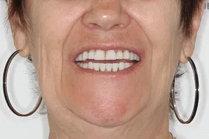 Протезирование All-on-4 для восстановления нижней челюсти