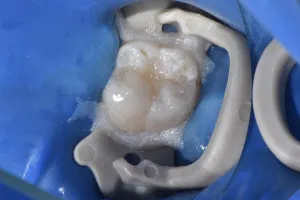 Лечение кариеса жевательного зуба ПОСЛЕ