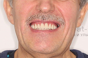 Имплантация зубов после зубного моста