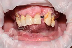 Восстановление зубов методом All-on-4