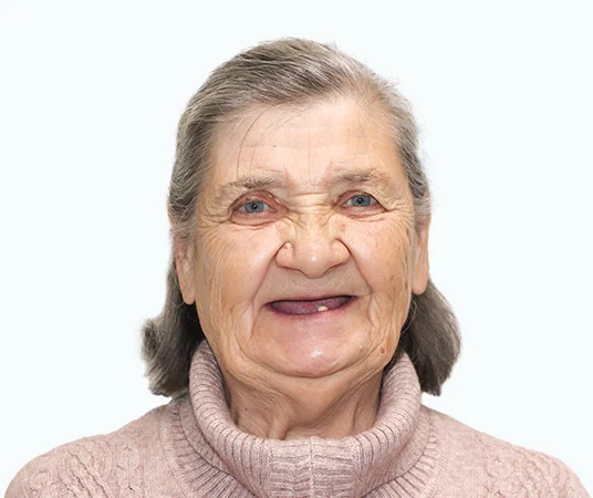 Фото до имплантации зубов