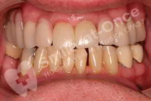 Лечение зубов и установка съемного протеза