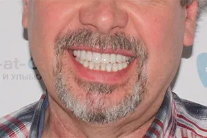 Разрушенные зубы - протезирование All-on-6