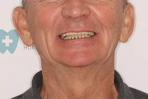 Восстановление зубов после съемного протеза методом All-on-4
