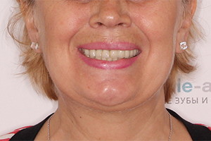 Имплантация всех зубов после мостовидных протезов