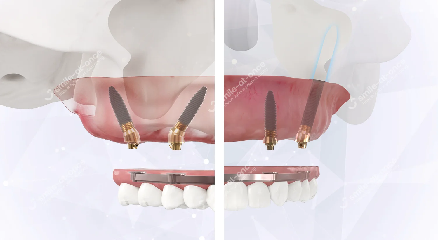 Скуловая имплантация Zygoma или V-II-V: помогаем выбрать