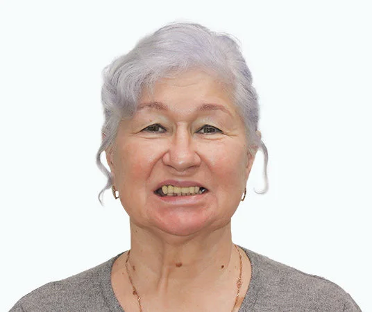 Фото до комплексной имплантации зубов