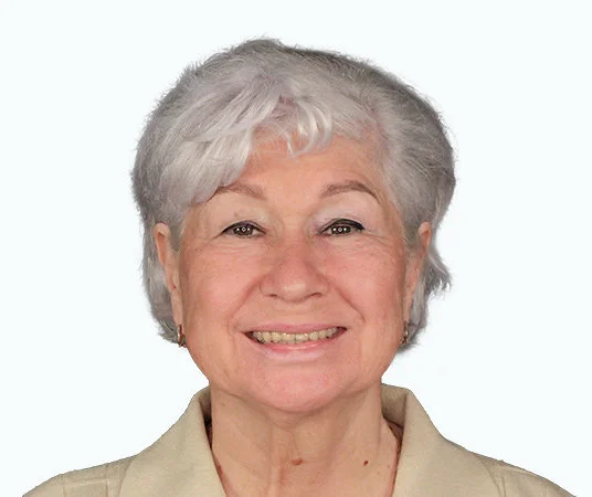 Фото после комплексной имплантации зубов