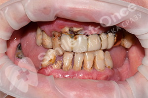 Имплантация после разрушения зубов