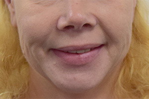 Замена зубных протезов на импланты