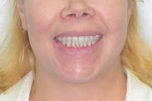 Замена зубных протезов на импланты - до