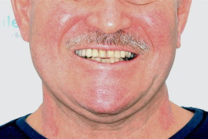 Протезирование нижней челюсти All-on-4 - до
