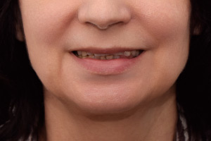 Имплантация all-on-6 и виниры на зубы ДО
