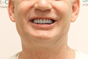 Имплантация всех зубов верхней челюсти