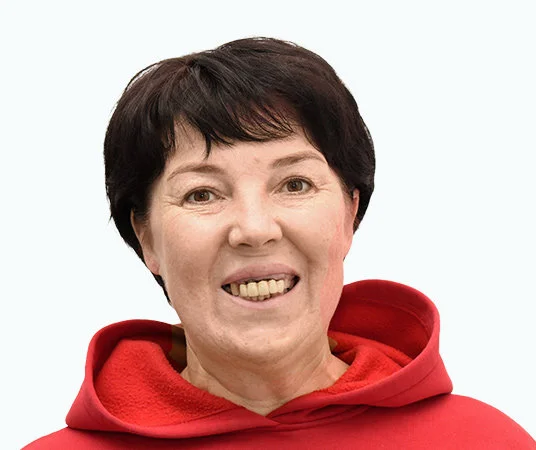 Фото до проведения имплантации зубов