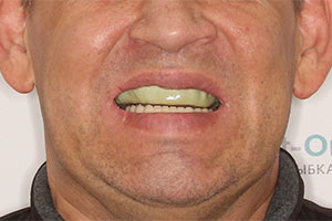 Basal Complex на верхней челюсти