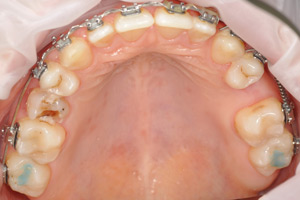 Одиночная имплантация после ортодонтического лечения, фото до