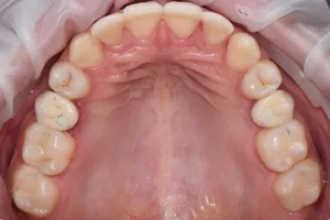 Одиночная имплантация после ортодонтического лечения, фото после