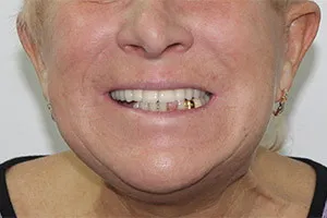 Восстановление зубов нижней челюсти - All-on-6