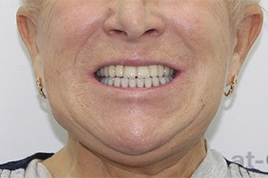 Восстановление зубов нижней челюсти - All-on-6