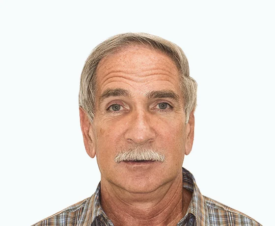 Фото до имплантации зубов