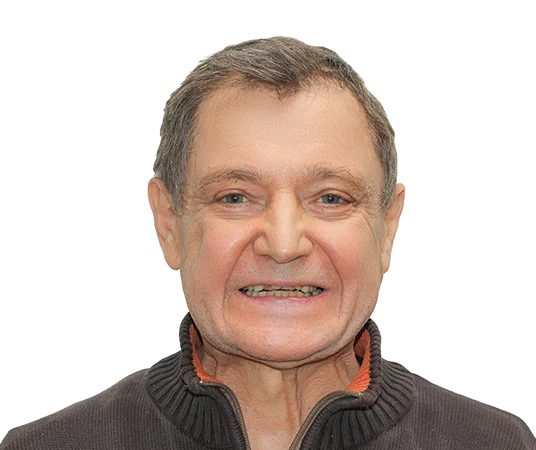 До имплантации all-on-4