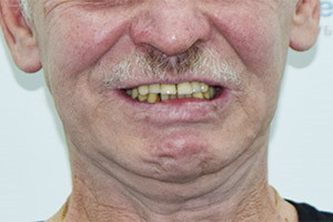 Basal Complex восстановление верхней челюсти