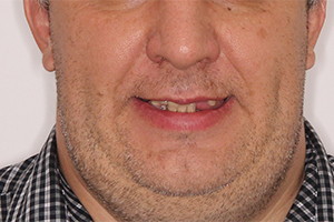 Восстановление зубов на двух челюстях