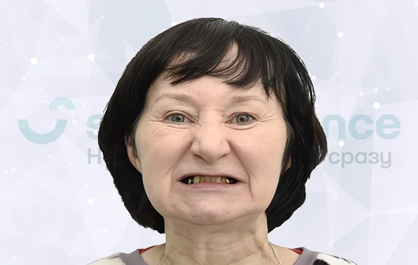 Имплантация всех зубов all-on-4 Nobel Biocare до