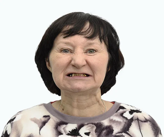 Фото до проведения имплантации всех зубов