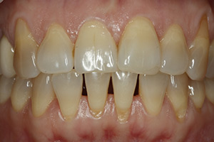 Хирургическое лечение оголенных зубных корней ДО