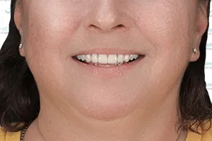 Тотальное восстановление зубов: all-on-6, импланты и виниры ПОСЛЕ