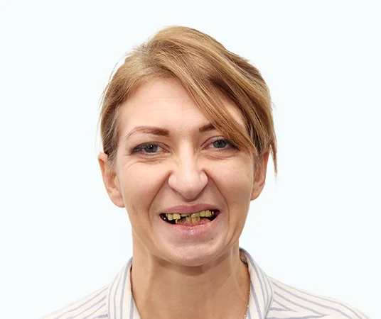 Фото: ДО имплантации