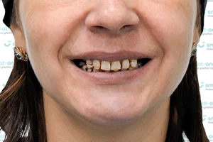 Импланты и коронки для восстановления всех зубов ДО
